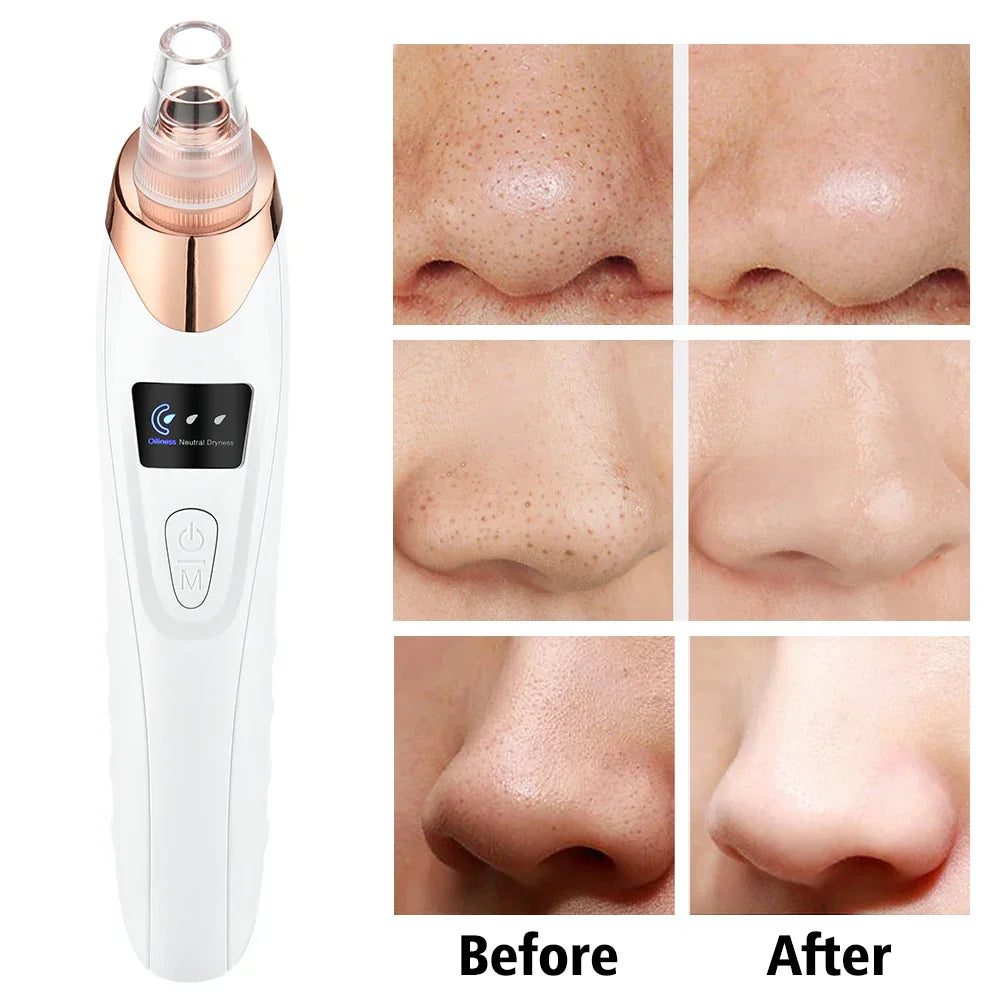 Derma Pore Cleaner Acne Oil Remover